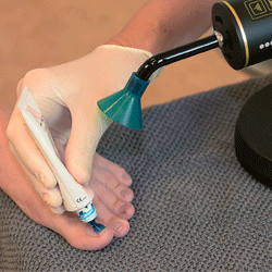 laserbehandling-aabenaa-fodklinik