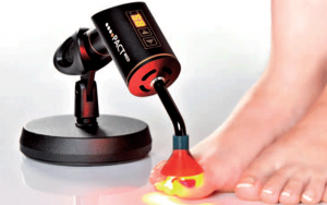 laserbehandling-neglesvamp-1